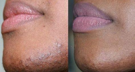 female facial hair removal