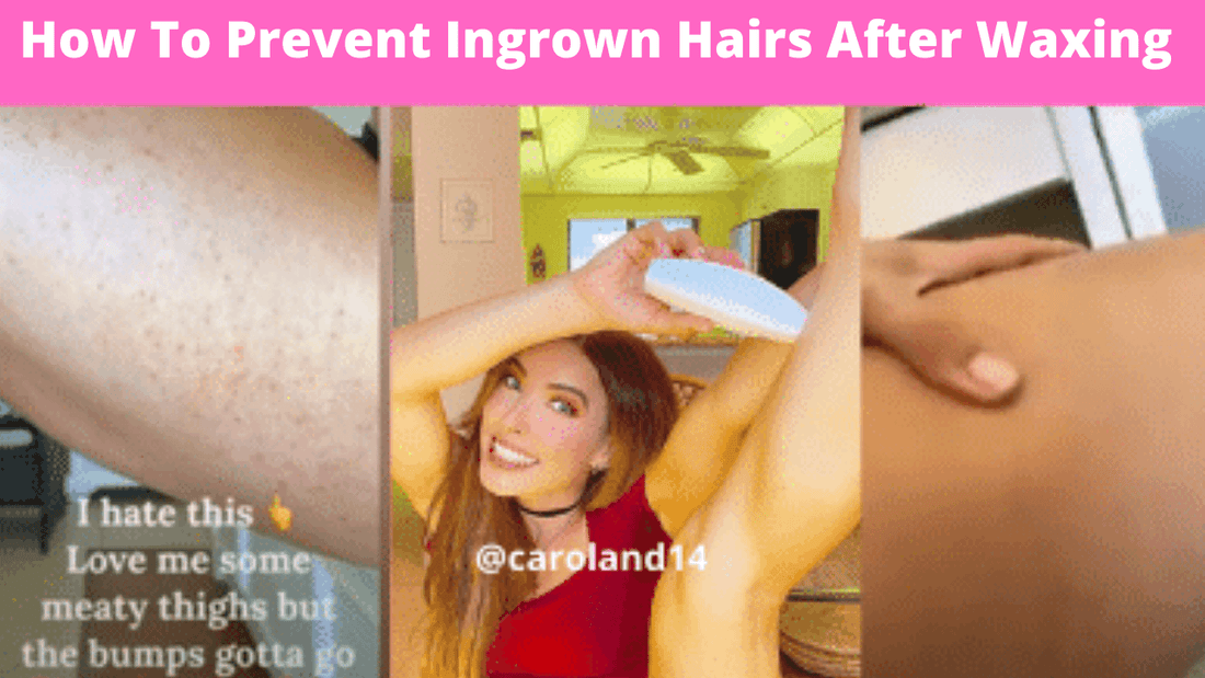 How To Prevent Ingrown Hairs After Waxing