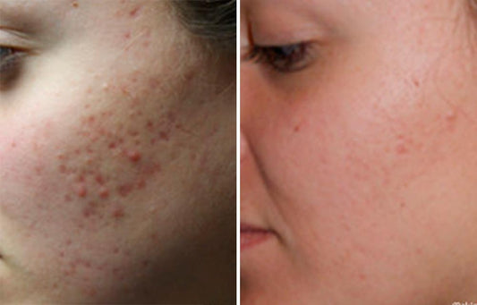 Treatment for acne scar on face