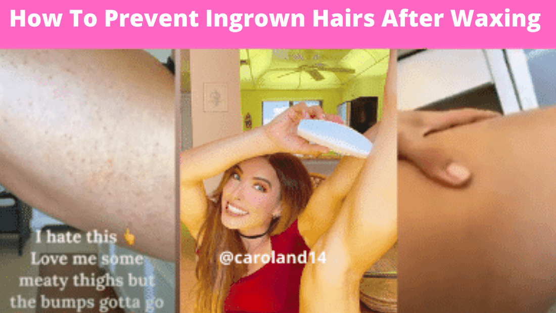 How To Prevent Ingrown Hairs After Waxing 