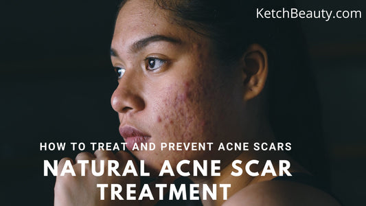 Natural acne scar treatment