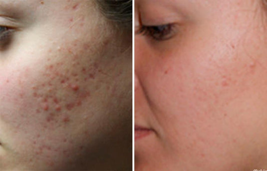 Treatment for acne scar on face 