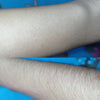 KetchBeauty V4.1 IPL Hair Removal Handset